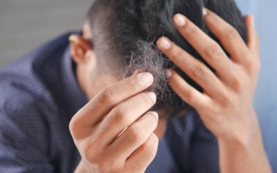 Saw Palmetto for hair loss: Does it work