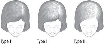 Hair loss treatment - Female pattern hair loss
