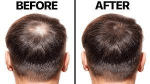 hair loss minoxidil